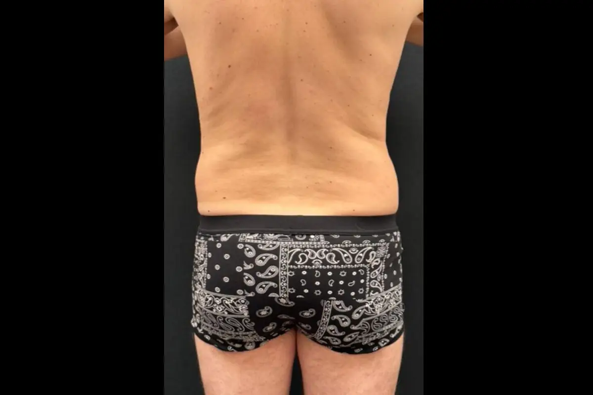 Foto Prima Liposuzione - Caso 3